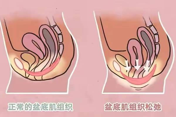 女性产后42天复查盆底肌用不用空腹到医院做检查？