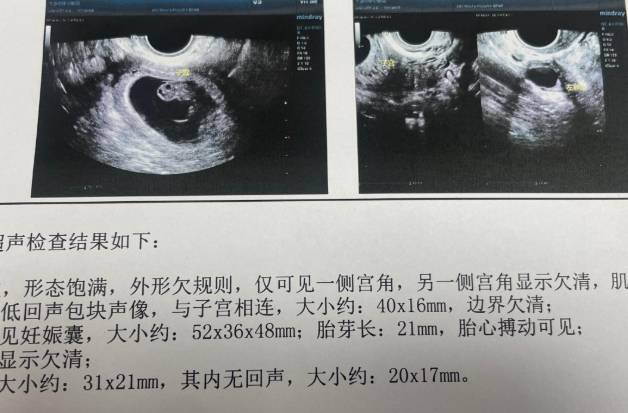 孕囊形态欠规则要引起重视