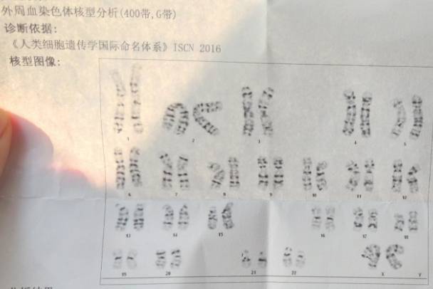 备孕前必读，染色体检查项目解析