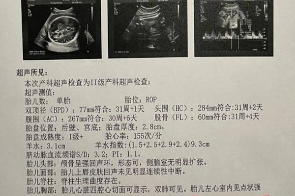 唐筛过了但是左心室有强光点是正常的吗?