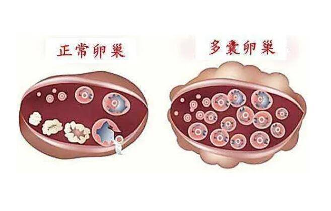 小姑娘多囊卵巢怎么办，多囊卵巢综合症常见治疗方法有哪些?