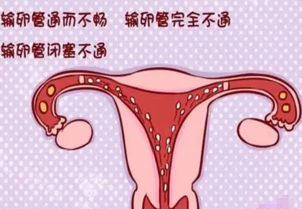 女性输卵管不通直接做二代试管婴儿痛苦吗？